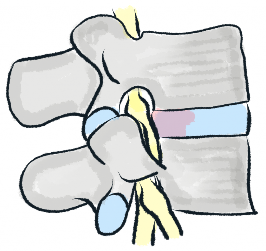 Bel fıtığı – bulging, sinir köklerine bası yaptığı veya diskin içindeki sinir uçlarını rahatsız ettiği için ağrı yapabilir.