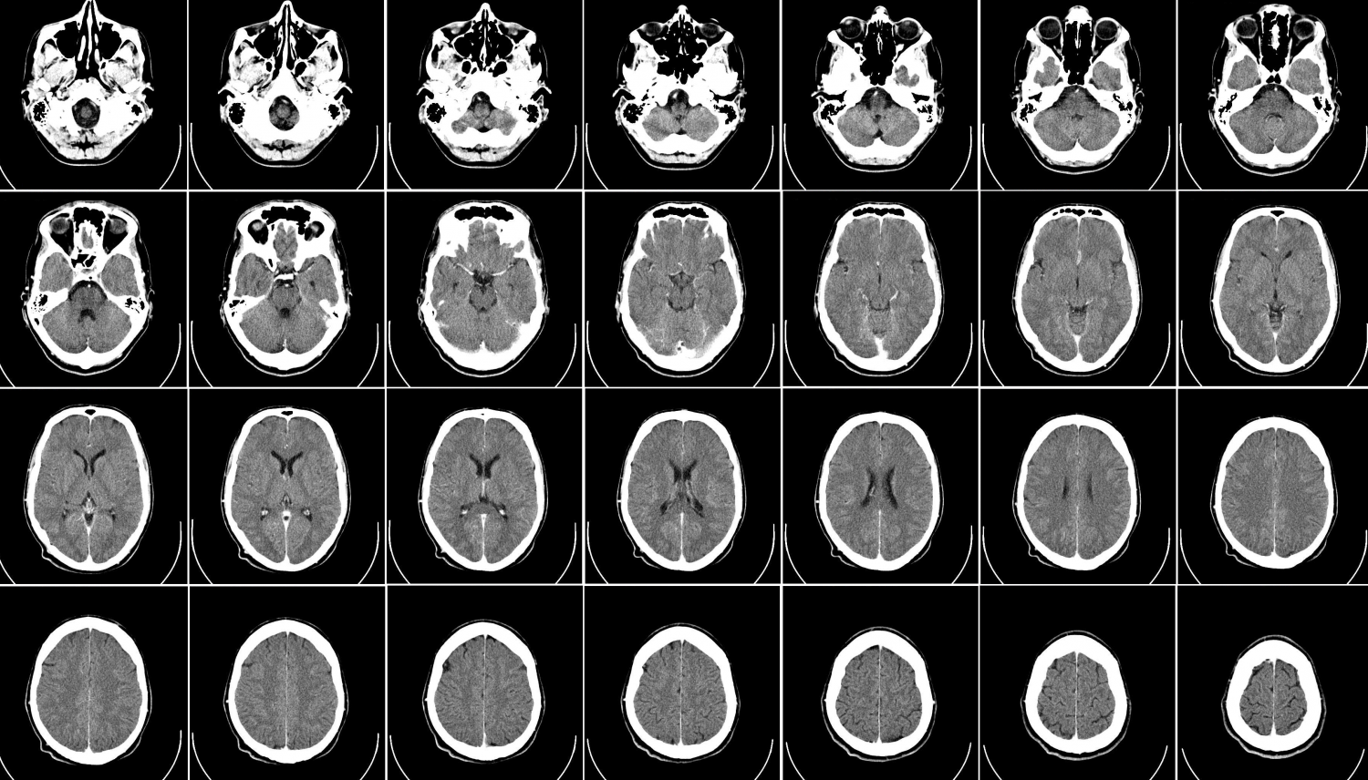 Sag Taraftaki Beyin Damari Tikanirsa Ne Olur Doktor Fizik