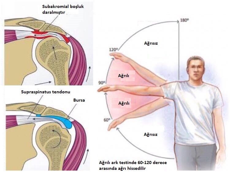 Omuz Sikismasi Nedir Impingement Sendromu Doktor Fizik