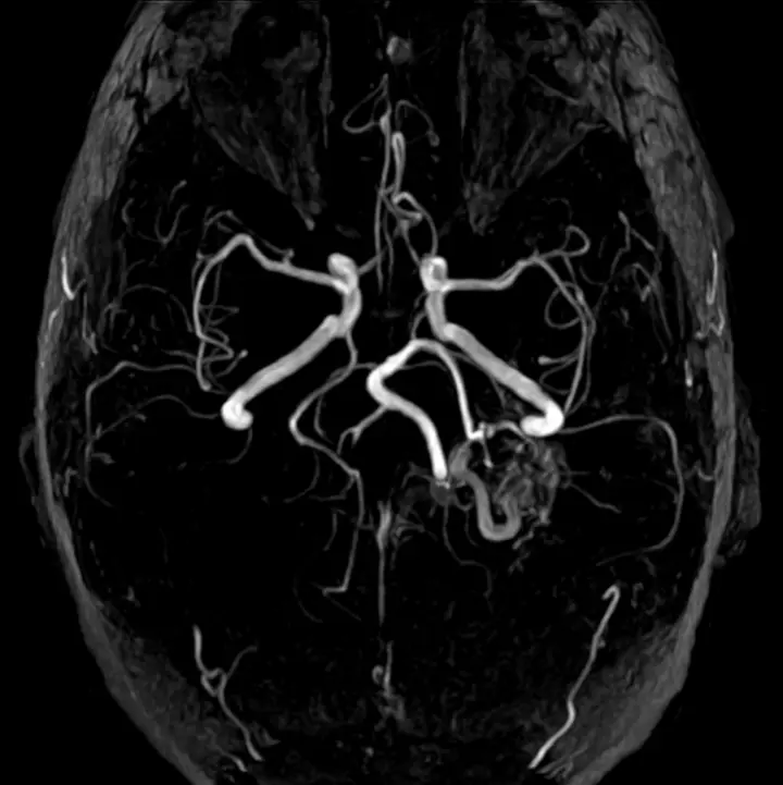 Arteriyo-Venöz Malformasyon (AVM) Nedir? Neden Olur? Belirtileri