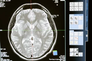 beyin tümörü tedavisi nasıl yapılır