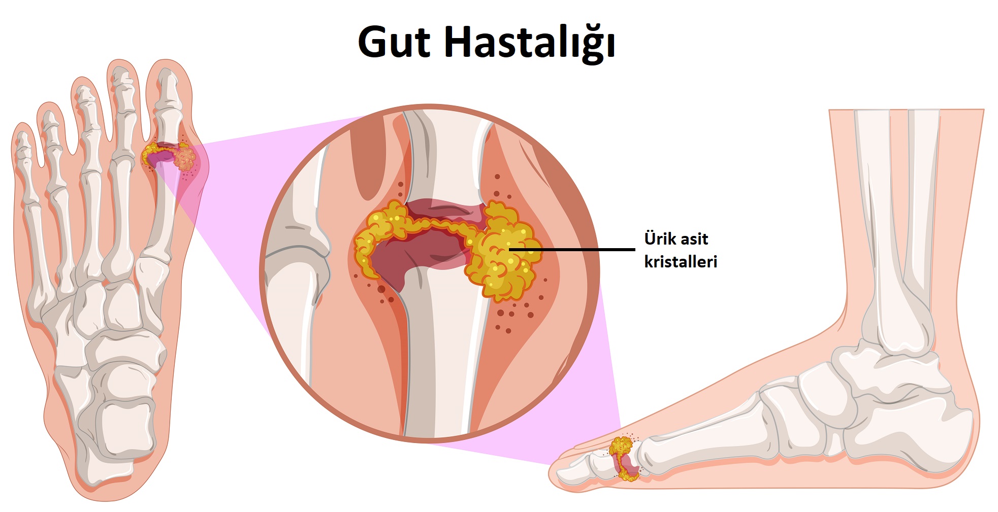 Gut hastalığı nedir? Belirtileri ve tedavi yöntemleri nelerdir? | Anadolu Sağlık Merkezi