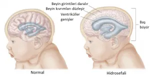Beyinde Sıvı Birikmesi – Hidrosefali