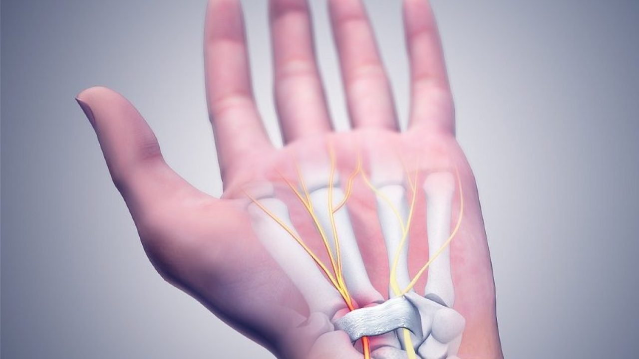 Sinir Sikismasi Nedir Neden Olur Tipleri Doktor Fizik