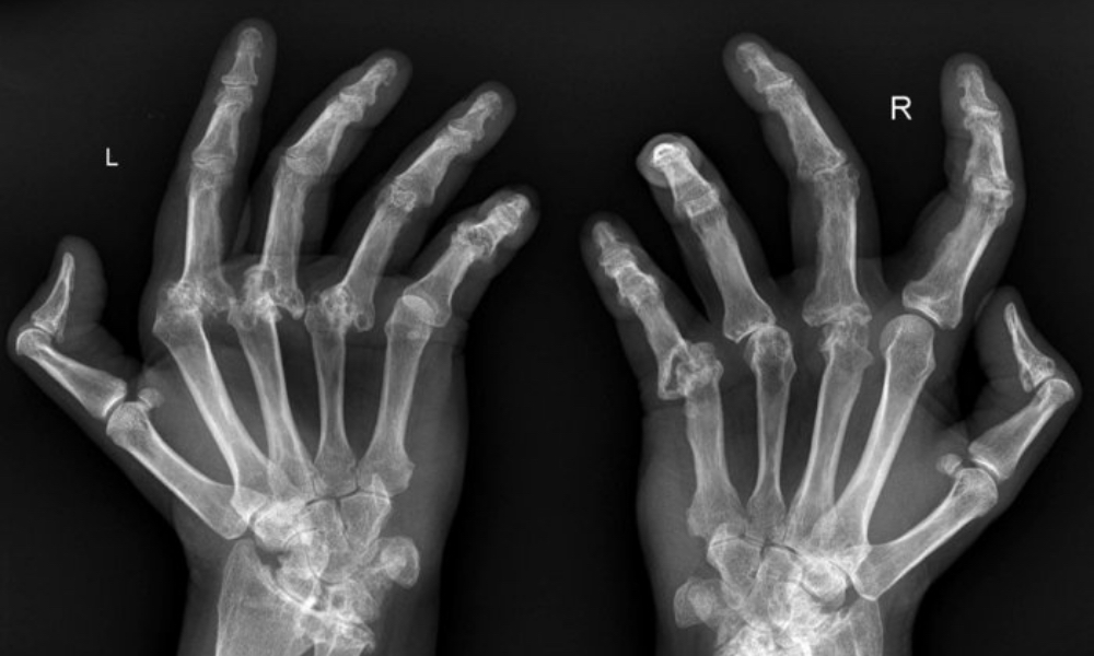 Romatoid Artrit Nedir Iltihapli Romatizma Belirtileri Romatoid Artrit Nedir Iltihapli Romatizma Belirtileri