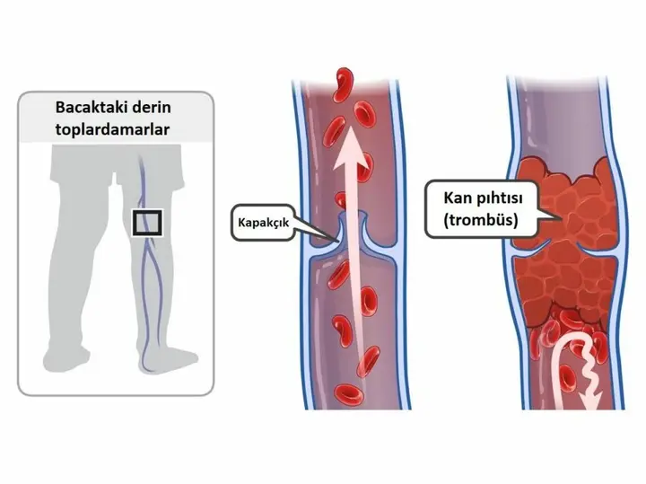 Bacak Damarlarında Pıhtı Oluşması – Derin Ven Trombozu