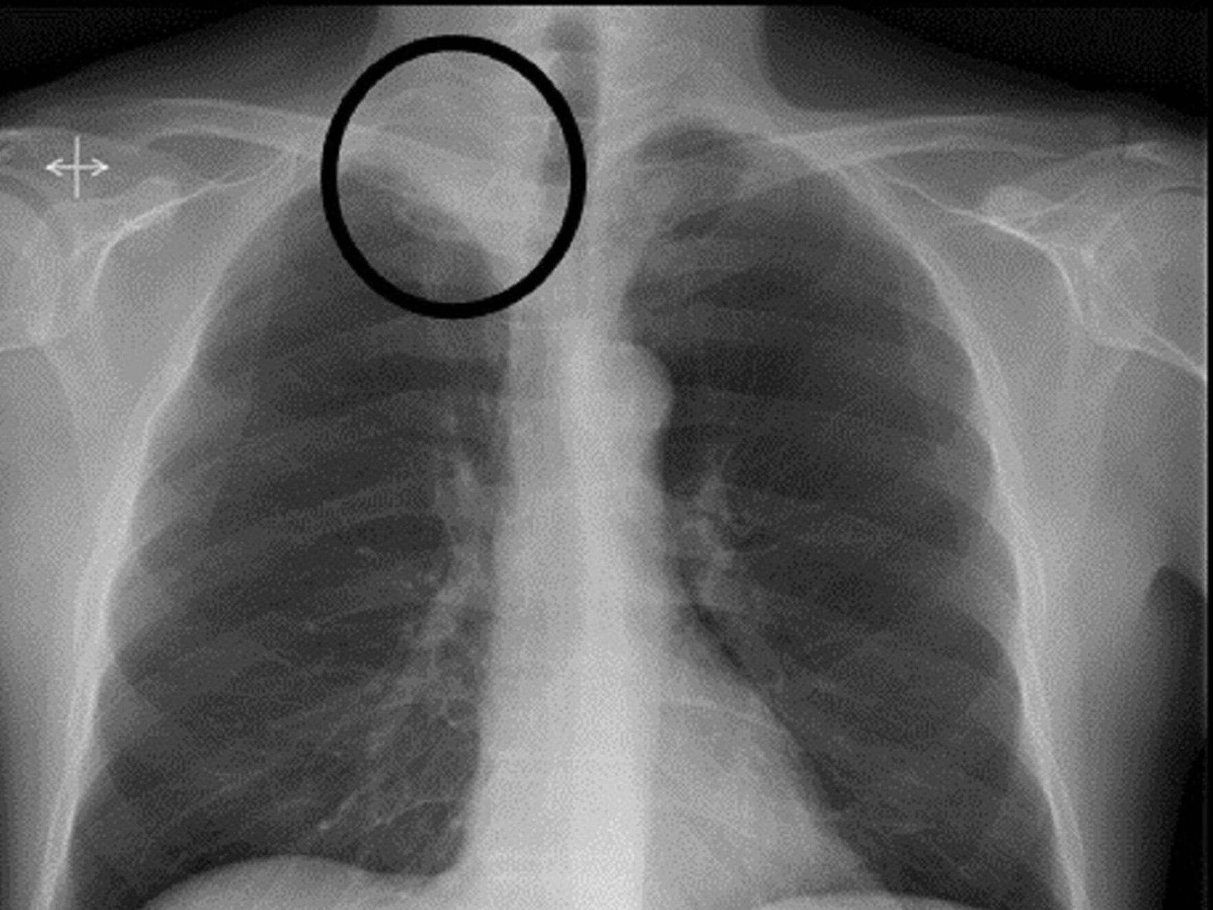 Pancoast Sendromu Pancoast Tümörü Nedir? Doktor Fizik Pancoast Sendromu Pancoast Tümörü Nedir? Doktor Fizik