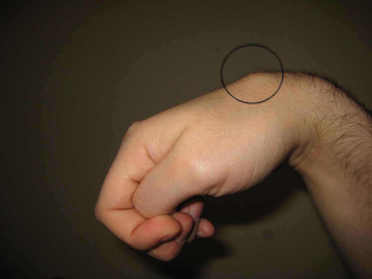 Ganglion Kisti Nedir