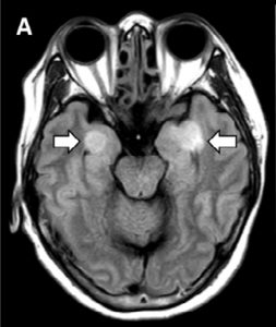 beyin mri, hemoraji, ensefalit