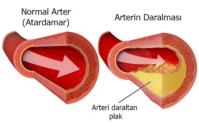 Kaynak: https://commons.wikimedia.org/wiki/File:Atherosclerosis.jpg