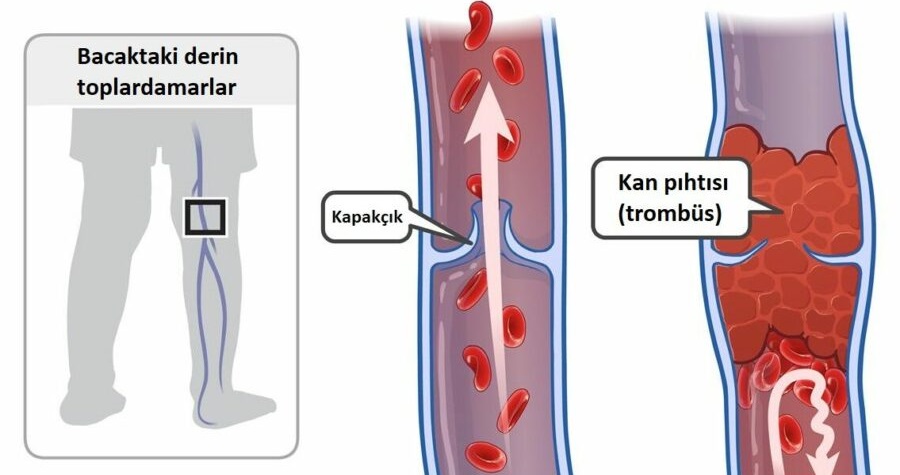 Toplardamarda pıhtı oluşumu bacak ağrısı sebeplerinden biridir.