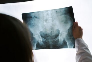 kalca protezi ameliyati nedir