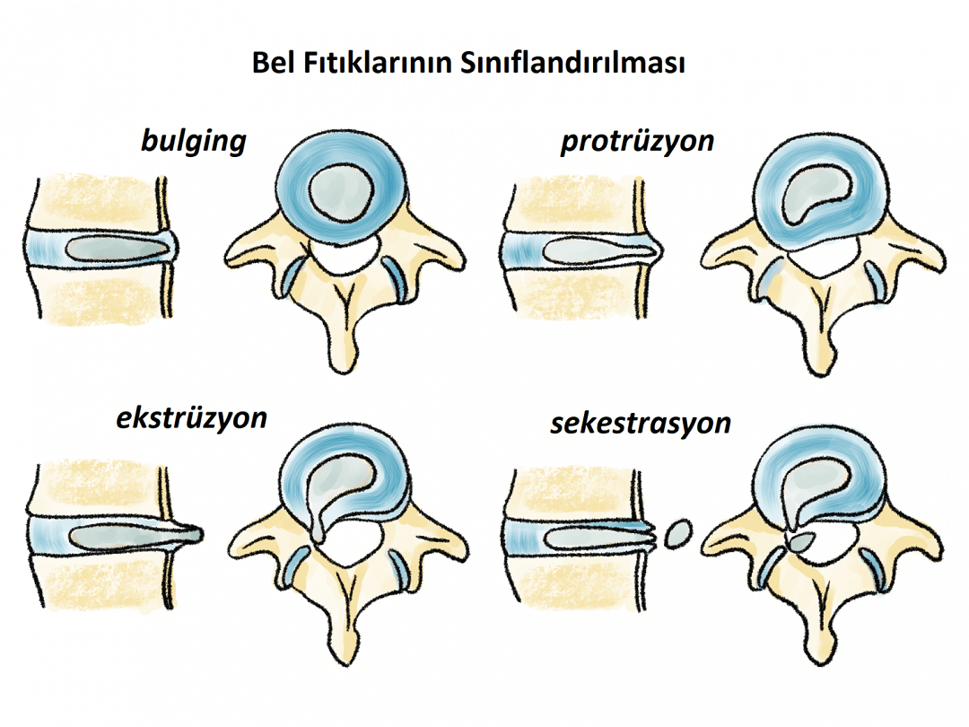 protruzyon nedir