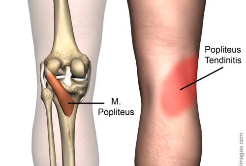 popliteus tendinitis