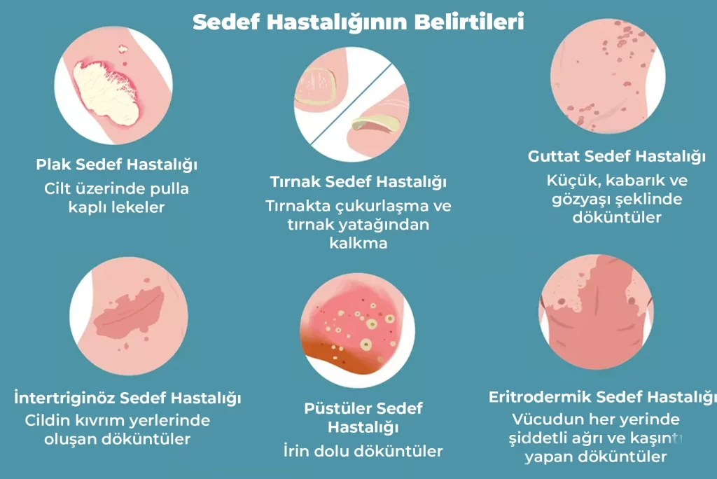 sedef hastalığı belirtileri nelerdir