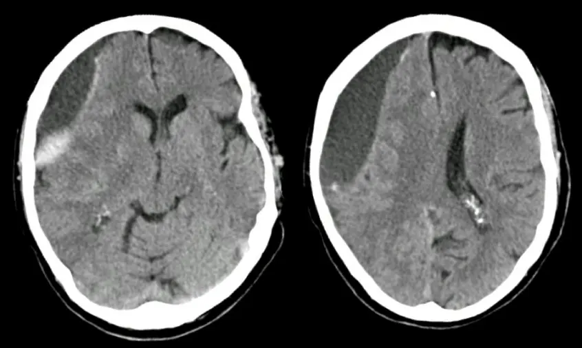 Subdural hematom Mr görüntüsü