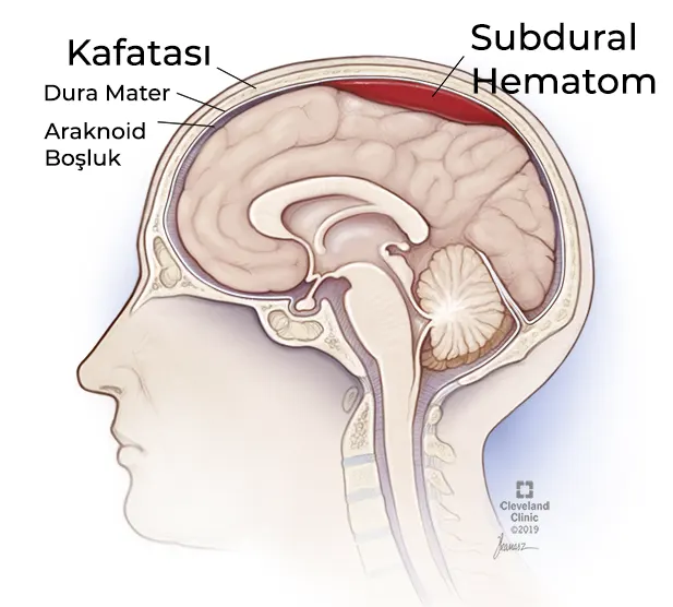 subdural hematom belirtileri